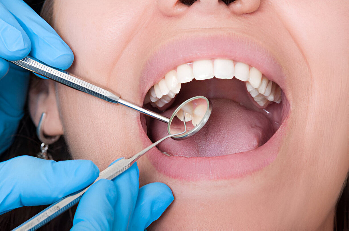 Tips for Healing After a Tooth Extraction in Houston